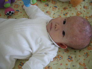 hydrocephalus_baby